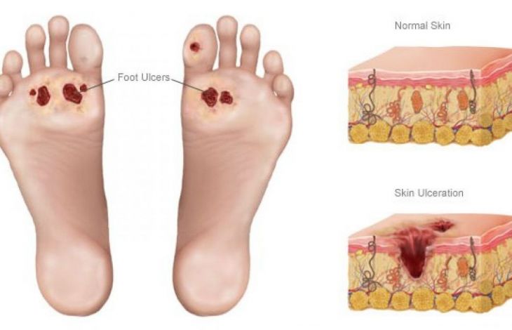 Metode de prevenire a piciorului diabetic