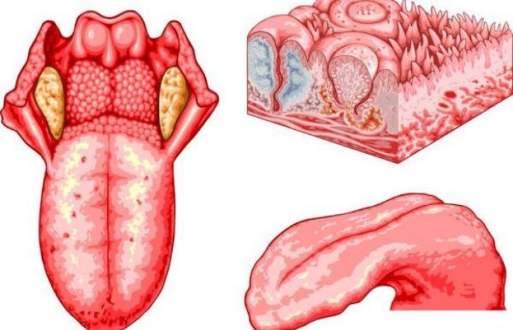 10 simptome ale unor boli vizibile la nivelul limbii