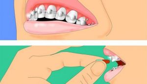 Cum se curata un aparat dentar?