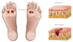 Metode de prevenire a piciorului diabetic