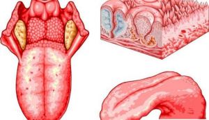 10 simptome ale unor boli vizibile la nivelul limbii